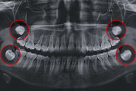 A dental X-ray that highlights a patient’s wisdom teeth