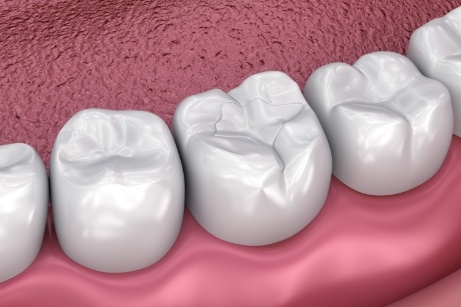 Illustration of dental sealant applied to teeth