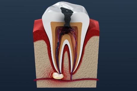 Illustration of infected tooth before pulp therapy