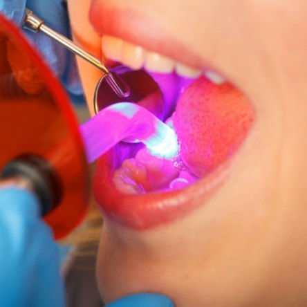 Close up of patients mouth during dental bonding process