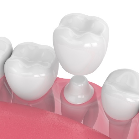 Digital illustration of a dental crown