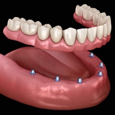 Illustration of dentures being attached to dental implants