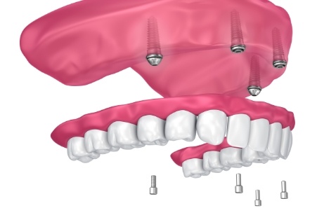 Illustration of implant dentures being removed