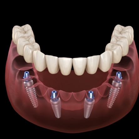 Illustration of dentures and four dental implants