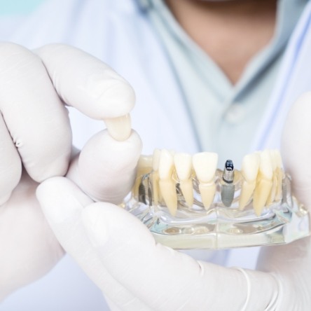 Holding model of dental implant and a crown