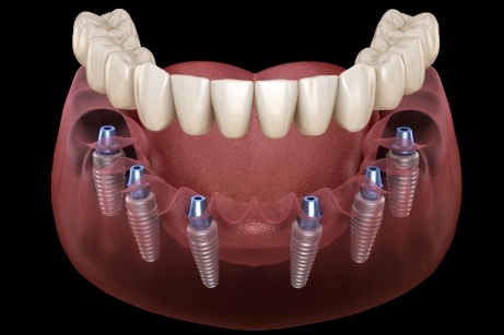 Illustration of dentures being attached to six dental implants