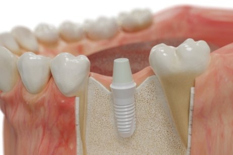 Close up of model of dental implant in mouth