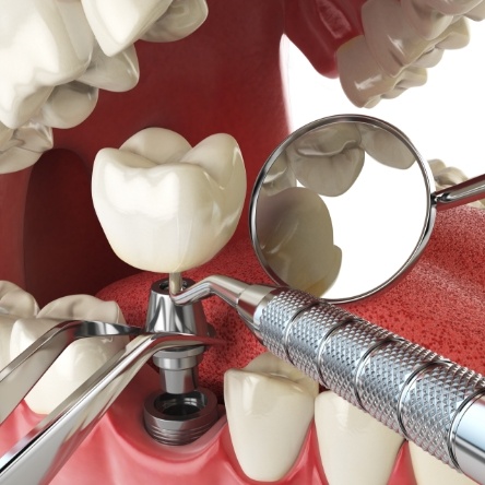 Dental implant post, crown, and abutment being placed