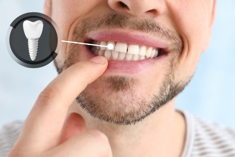 Man pointing to smile with dental implant indicated