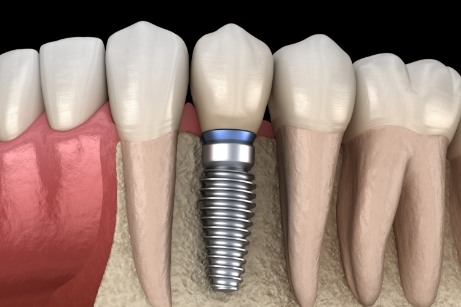 Illustration of dental implant in jawbone