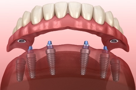 Dentures being attached to dental implants