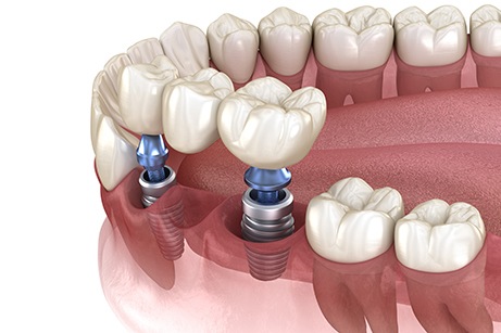 Example of dental implants at TrueCare Dentistry