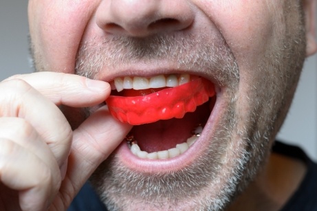 Man putting in a mouthguard
