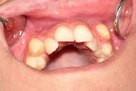 Close up of badly misaligned teeth
