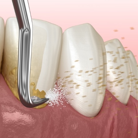 Scaling and root planing for gum disease treatment in Mesquite
