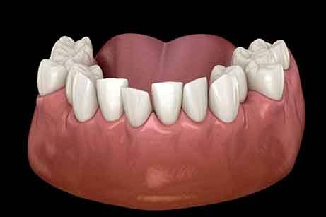 Crowded set of teeth