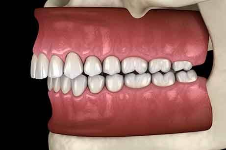 Image of an overbite