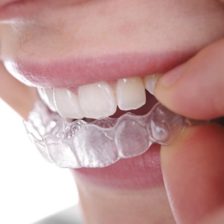 Close up of teeth while aligners are being put in