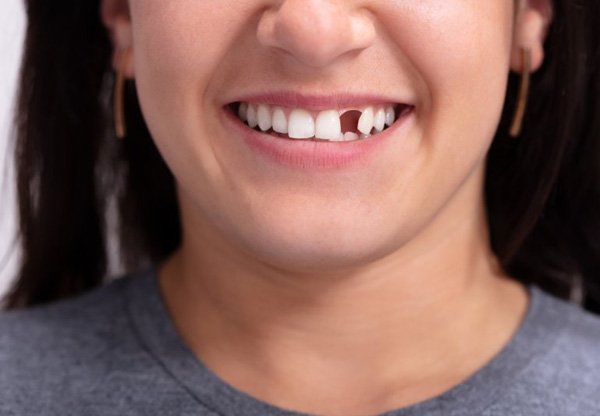 Patient in Balch Springs smiling with missing tooth