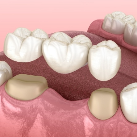 Illustration of dental bridge in Mesquite being attached to tooth