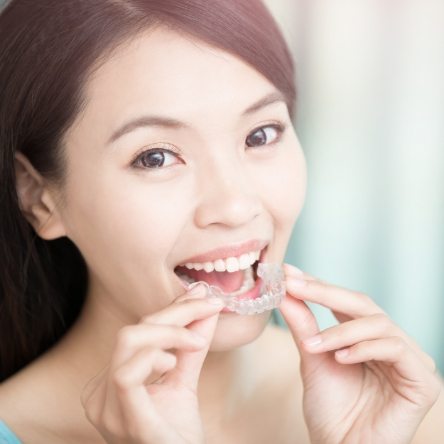 Woman about to put in an Invisalign aligner