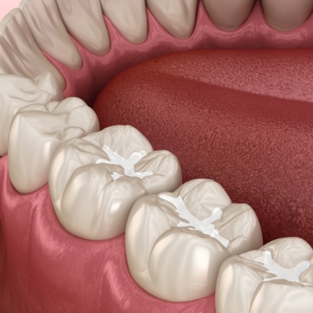 Illustration of decayed teeth repaired with tooth colored fillings