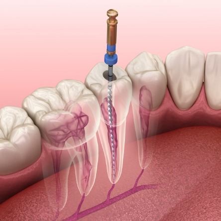 Illustration of a root canal treatment in Mesquite