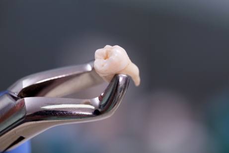 Tooth being held with a forcep