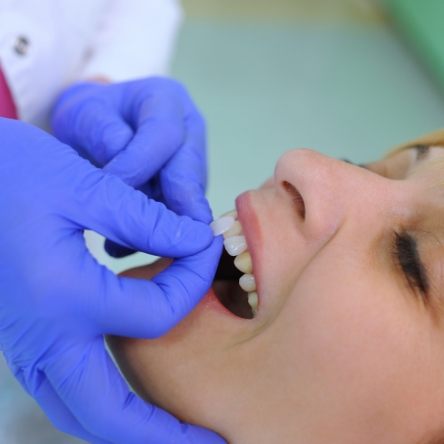 Placing veneers on female patients teeth
