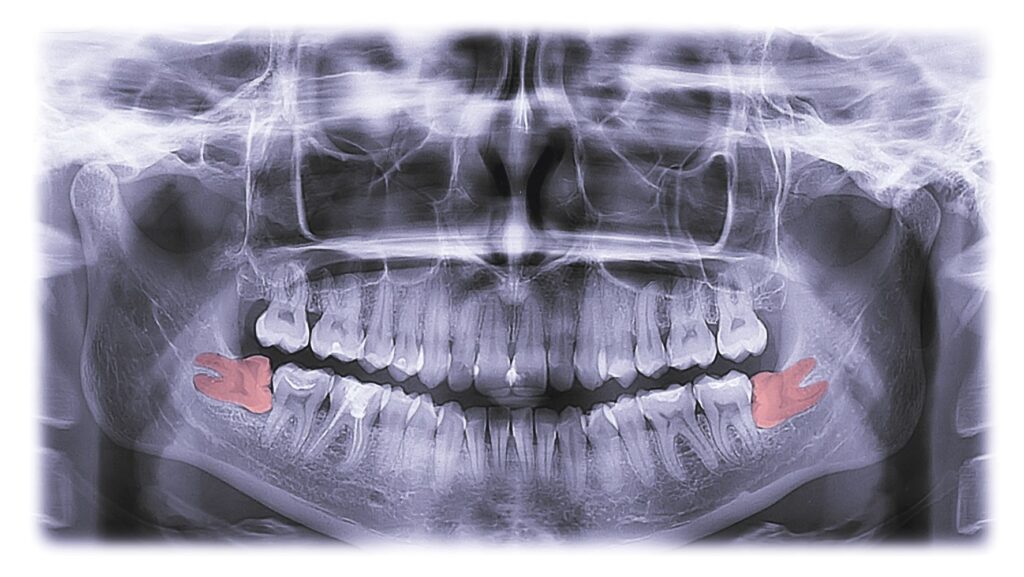 X-ray showing two wisdom teeth in bottom arch highlighted red